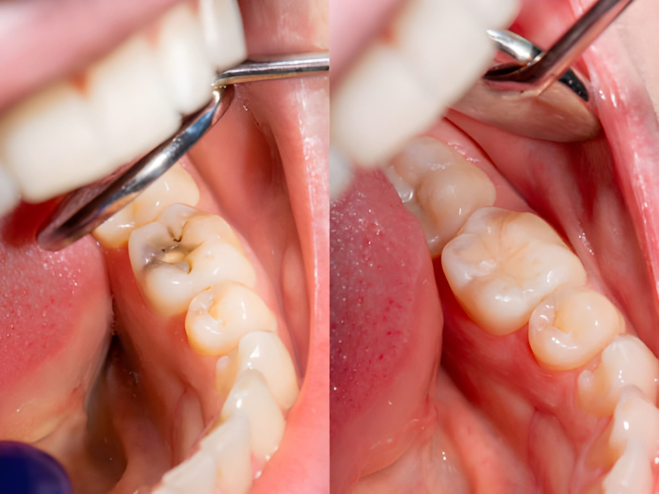 Dental Sealants In Calgary